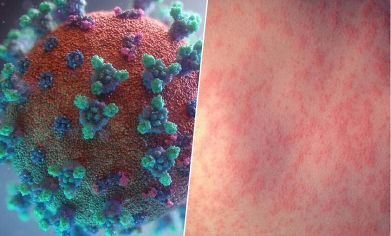 Imagen de un virus del sarampión