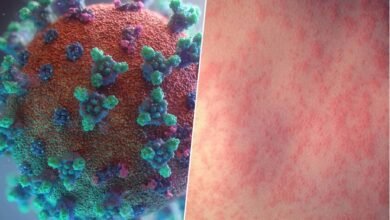 Imagen de un virus del sarampión bajo el microscopio