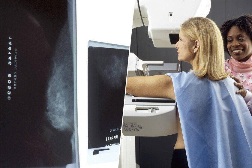 Mamografía con inteligencia artificial