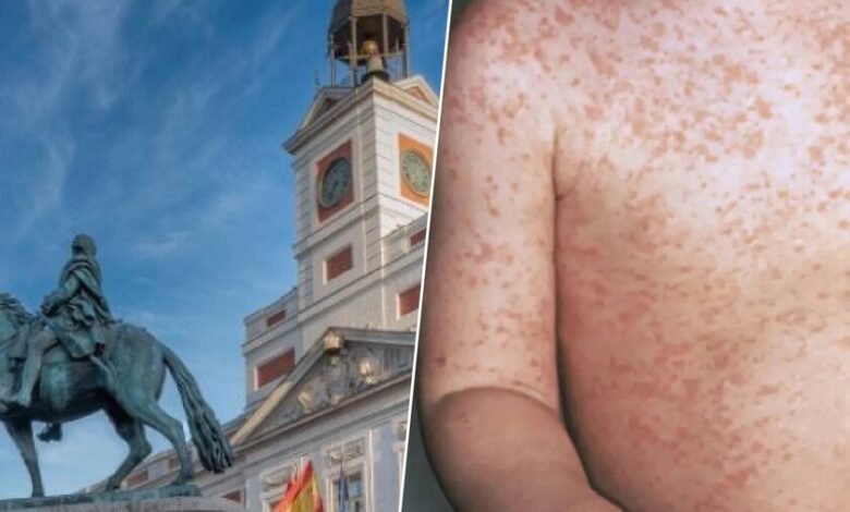Imagen de un médico con mascarilla y guantes examinando a un paciente con sarampión