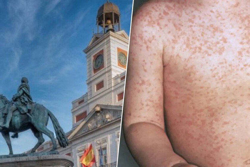 Imagen de un médico con mascarilla y guantes examinando a un paciente con sarampión