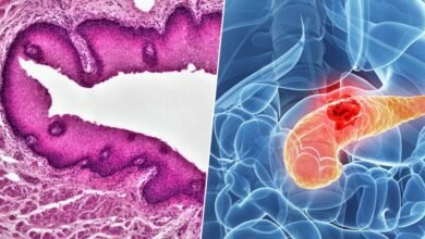 Ilustración de un páncreas humano con células cancerígenas