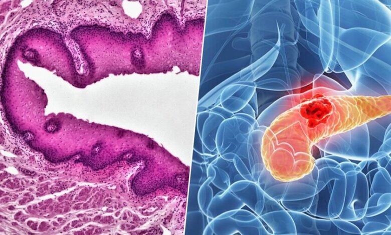 Ilustración de un páncreas humano con células cancerígenas