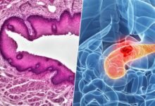 Imágenes de células cancerígenas y lesiones precursoras microscópicas en el páncreas