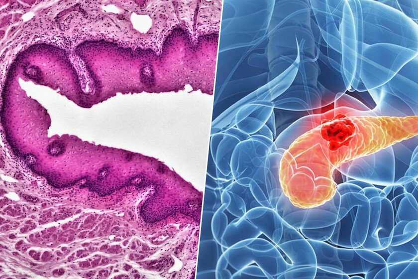 Imágenes de células cancerígenas y lesiones precursoras microscópicas en el páncreas