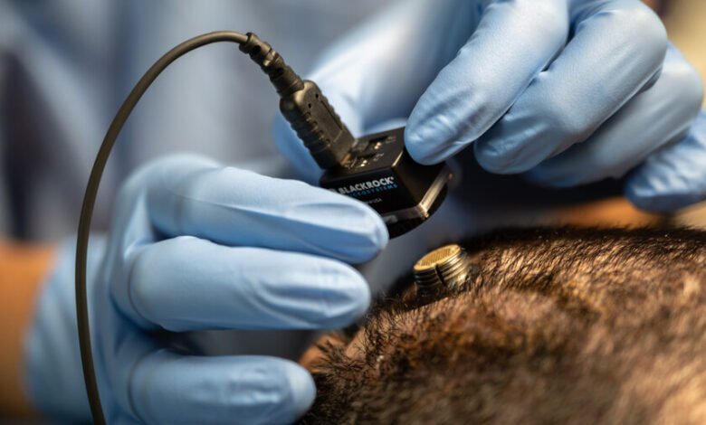 Imagen de un implante cerebral siendo colocado en el cerebro, representando la integración de la tecnología con el cuerpo humano.