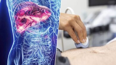 Ilustración de un hígado sano y uno con enfermedad del hígado graso