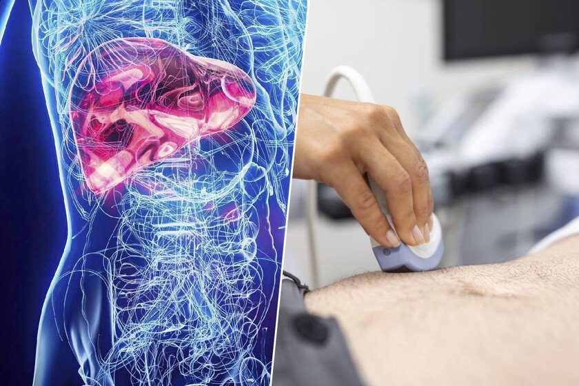 Ilustración de un hígado sano y uno con enfermedad del hígado graso