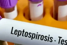 Imágenes de leptospirosis y síntomas