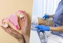 Mujer con síntomas de síndrome de ovario poliquístico