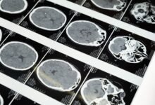 Ilustración del cerebro humano con áreas resaltadas que representan el envejecimiento y la mala salud metabólica