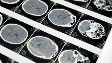 Ilustración del cerebro humano con áreas resaltadas que representan el envejecimiento y la mala salud metabólica