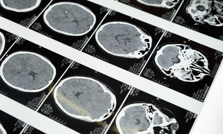 Ilustración del cerebro humano con áreas resaltadas que representan el envejecimiento y la mala salud metabólica